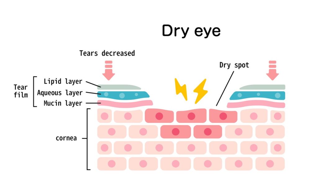 Dry Eye Disease Cause MGD
