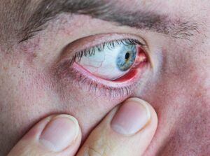 Oil Glands in Eyelid Meibomian Gland Dysfunction Dry Eye